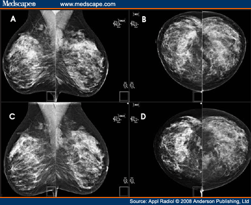 Digital Mammography Images